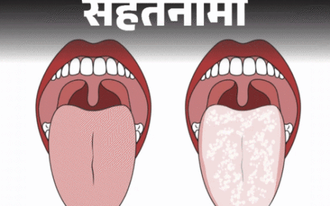 सेहतनामा- जीभ पर जमी सफेद लेयर:  क्या यह बीमारी का संकेत, ऐसा 7 कारणों से होता है, डॉक्टर से जानें बचाव के तरीके व सावधानियां