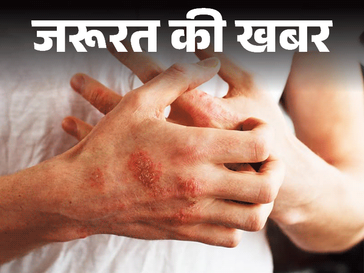 जरूरत की खबर- गर्मियों में बढ़ता दाद-खुजली का खतरा:  फंगल इंफेक्शन से बचाव के लिए आदतों में करें बदलाव, जानें लक्षण और बचाव के तरीके
