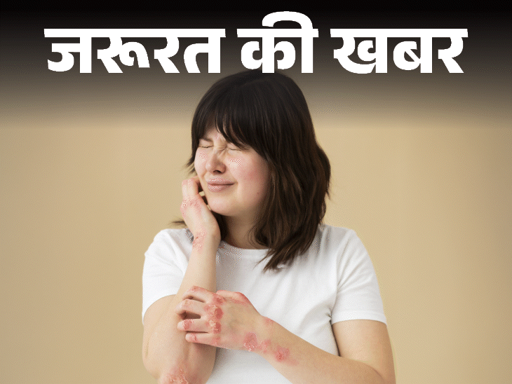 आप भी हैं खुजली से परेशान, इसे न करें नजरअंदाज:  हो सकता है एक्जिमा, डाॅक्टर से जानें इसके कारण, लक्षण और बचाव के तरीके