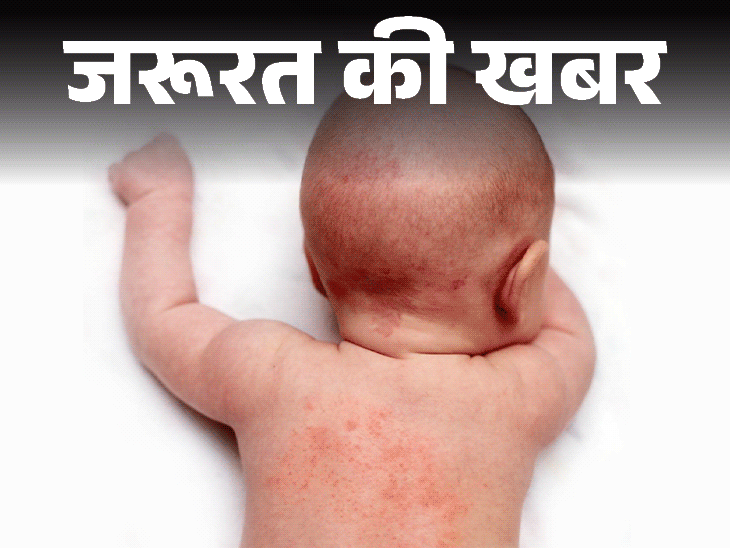 आप भी हैं घमौरियों से परेशान, अपनाएं ये घरेलू नुस्खे:  छोटे बच्चों से लेकर बड़े-बुजुर्ग तक इसके शिकार, जानें इसकी वजह और बचाव