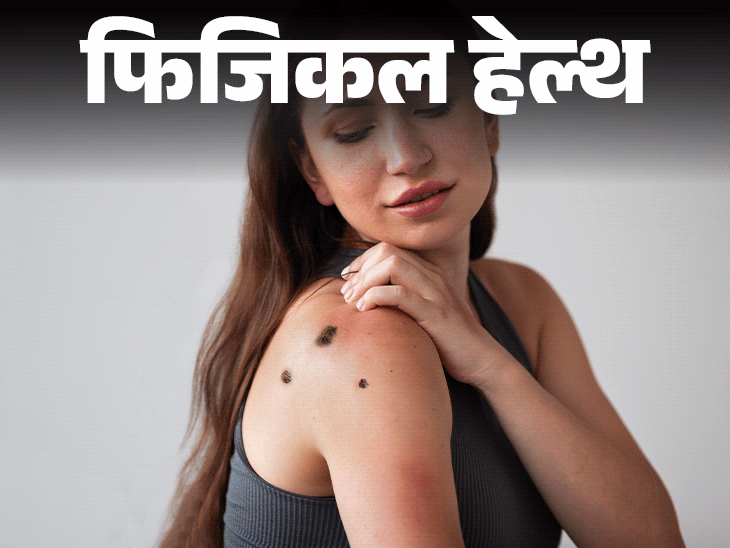 फिजिकल हेल्थ- रैशेज हो सकते हैं स्किन कैंसर का संकेत:  इन संकेतों को कैसे पहचानें, डॉक्टर से जानें किन लोगों को ज्यादा खतरा