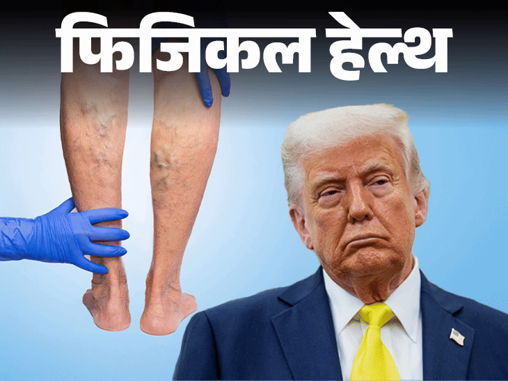 फिजिकल हेल्थ- डोनाल्ड ट्रंप को नसों की गंभीर बीमारी:  क्या है CVI, जिसमें नसों में होती सूजन, बचने के लिए 10 सावधानियां जरूरी