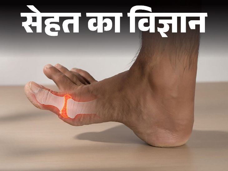 सेहत का विज्ञान- यूरिक एसिड बढ़ा तो गाउट का खतरा:  इसे बैलेंस कैसे रखें, कंट्रोल में रखने के पांच कारगर तरीके