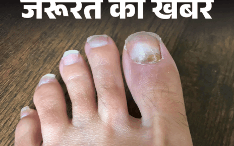 जरूरत की खबर- मानसून में नाखूनों का रखें खास ख्याल:  बढ़ता फंगल इन्फेक्शन और टूटने का रिस्क, डर्मेटोलॉजिस्ट से जानें नेल केयर टिप्स