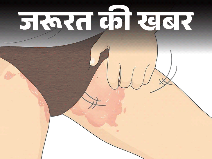 जरूरत की खबर- बारिश-उमस में बढ़ती थाई रैशेज की समस्या:  इन 7 कारणों से होते रैशेज, डॉक्टर से जानें बचाव के लिए 8 जरूरी सावधानियां