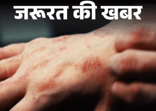 जरूरत की खबर- मानसून में बढ़ रहा स्किन इन्फेक्शन:  नमी से बढ़ता बैक्टीरियल और फंगल इंफेक्शन, जानें बचाव और इलाज के टिप्स