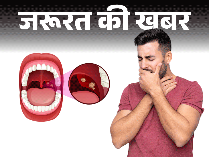 जरूरत की खबर- गले में दर्द हो सकता है टॉन्सिलाइटिस:  डॉक्टर से जानें ये क्या है, क्यों होता है, लक्षण और बचाव की जरूरी सावधानियां