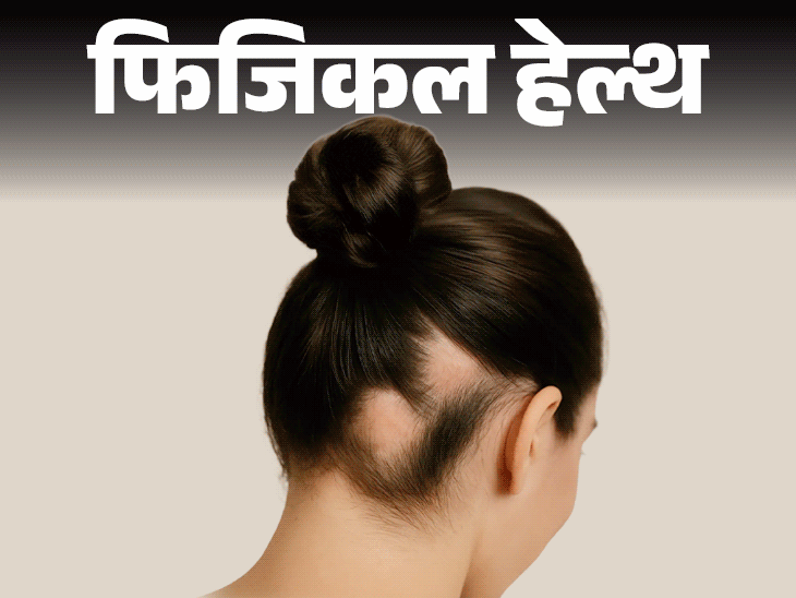 फिजिकल हेल्थ- क्या अचानक झड़ रहे हैं बाल:  हो सकता है एलोपेशिया, जानें क्या है ये ऑटोइम्यून बीमारी, क्या है इसका इलाज