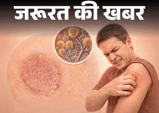 जरूरत की खबर- रिंगवार्म क्या है:  क्या यह संक्रामक हो सकता है, डॉक्टर से जानें फैलने का कारण, लक्षण और इलाज, न करें ये 9 गलतियां