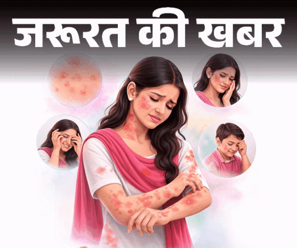 जरूरत की खबर- होली रंगों से स्किन पर रैशेज, दाने:  डर्मेटोलॉजिस्ट से जानें 10 घरेलू इलाज, ये 6 संकेत दिखें तो तुरंत डॉक्टर को दिखाएं