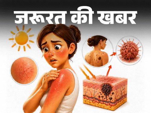 जरूरत की खबर- सनबर्न से बढ़ता स्किन कैंसर का रिस्क:  स्किन रखें हेल्दी, ये 7 संकेत इग्नोर न करें, सनबर्न से बचाव के 10 टिप्स