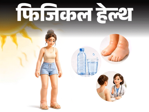 फिजिकल हेल्थ- हीट एडेमा क्या है:  गर्मियों में बढ़ते केस, डॉक्टर से जानें इसके लक्षण, किसे ज्यादा रिस्क, बचाव के लिए जरूरी सावधानियां